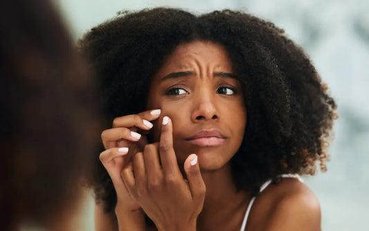 Recurring Face Acne and What to Do About It.